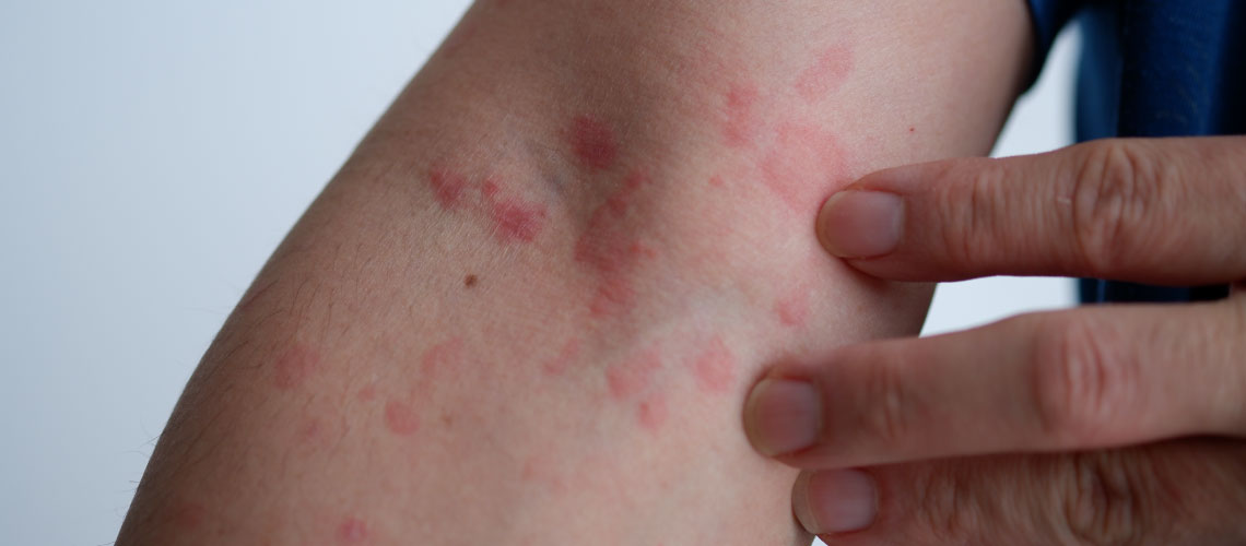 pessoa com urticaria