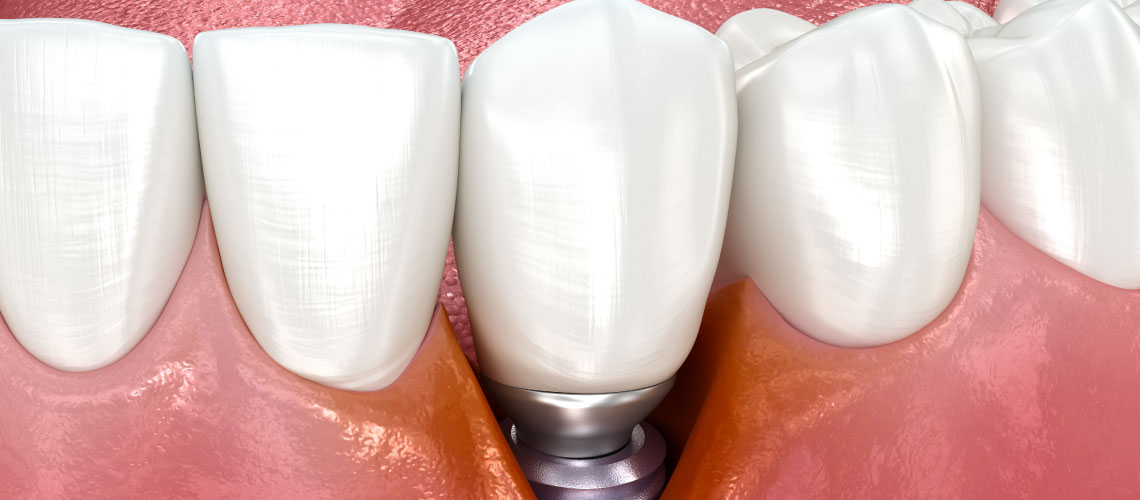 Periimplantite sob controlo: como a manutenção se pode transformar num aliado para o êxito clínico