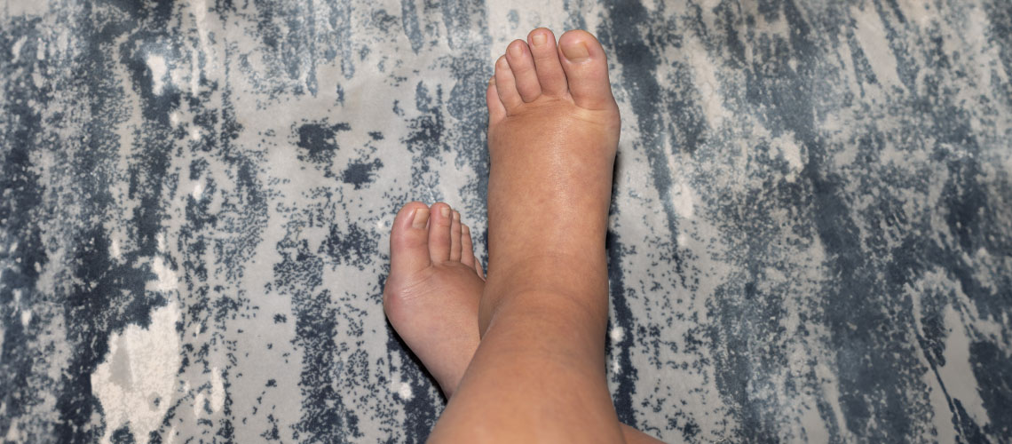 A corticoterapia e a retenção hidrossalina