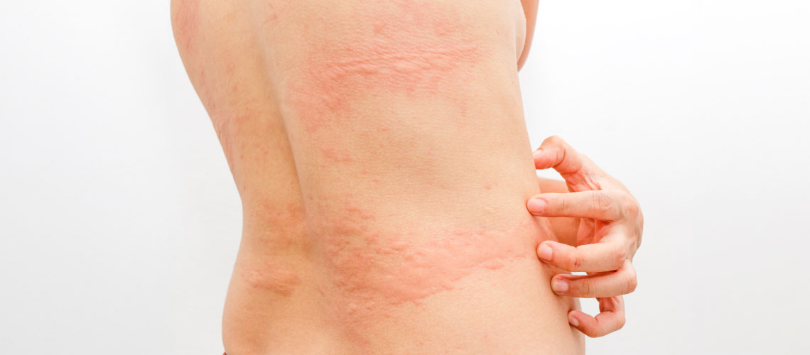 Urticária crónica: conhecer a doença para melhor tratar