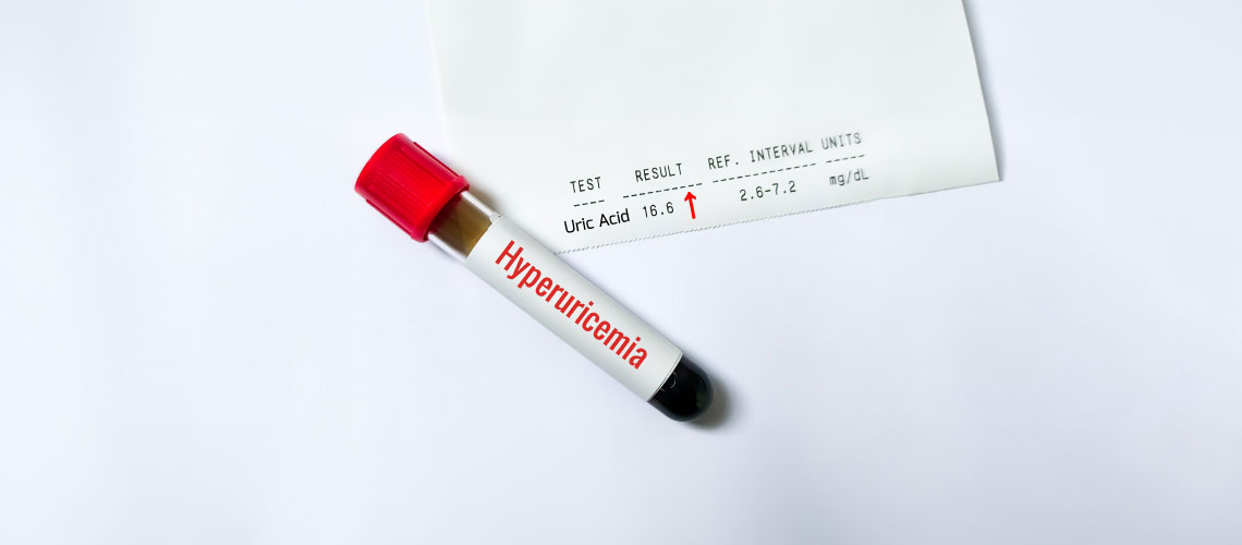 Alopurinol no controlo da hiperuricemia