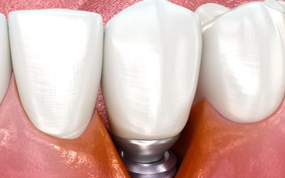 periimplantite-sob-controlo-1