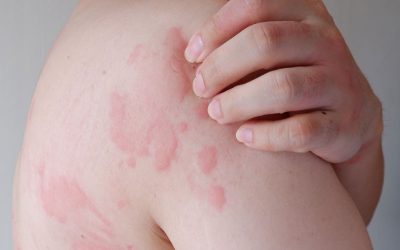 homem com urticaria a coçar-se