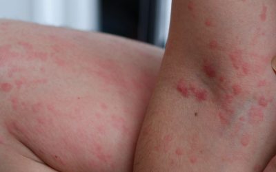 urticaria-cronica-1