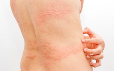 mulher com urticária