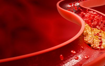“D” de Vitamina D e de Dislipidemia!